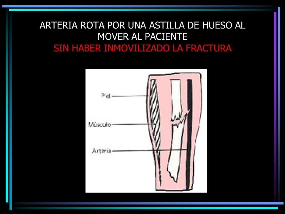 arteria rota en el pie arteria rota en el pie